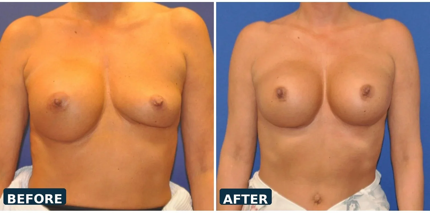Breast Revision