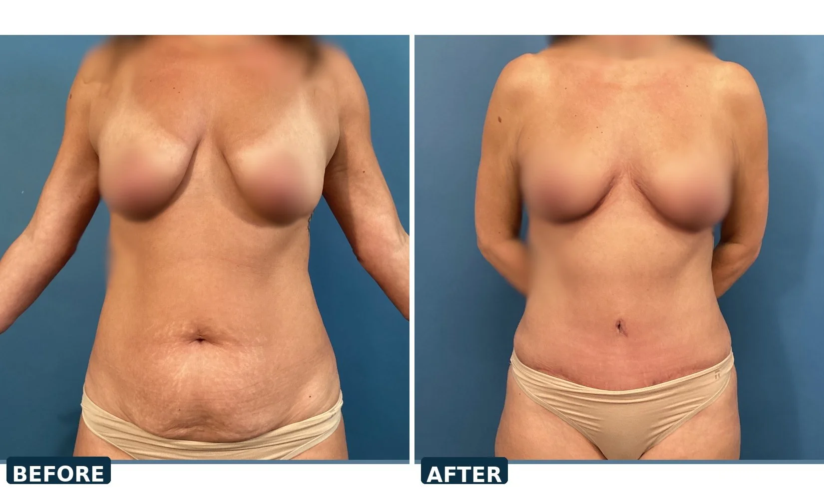 pearl-tummy-tuck-case-01-front-before-after.jpg