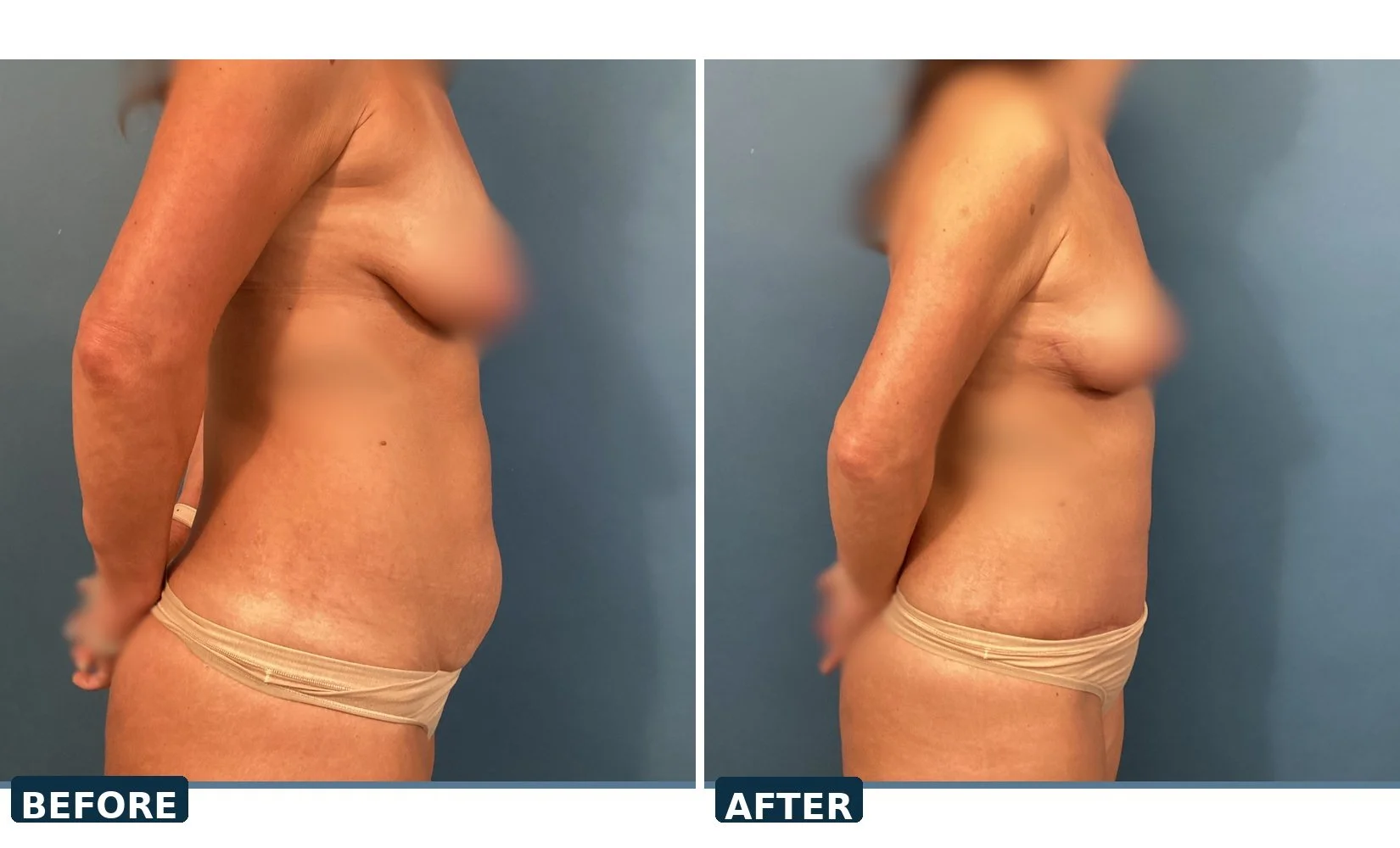 pearl-tummy-tuck-case-01-profile-before-after.jpg