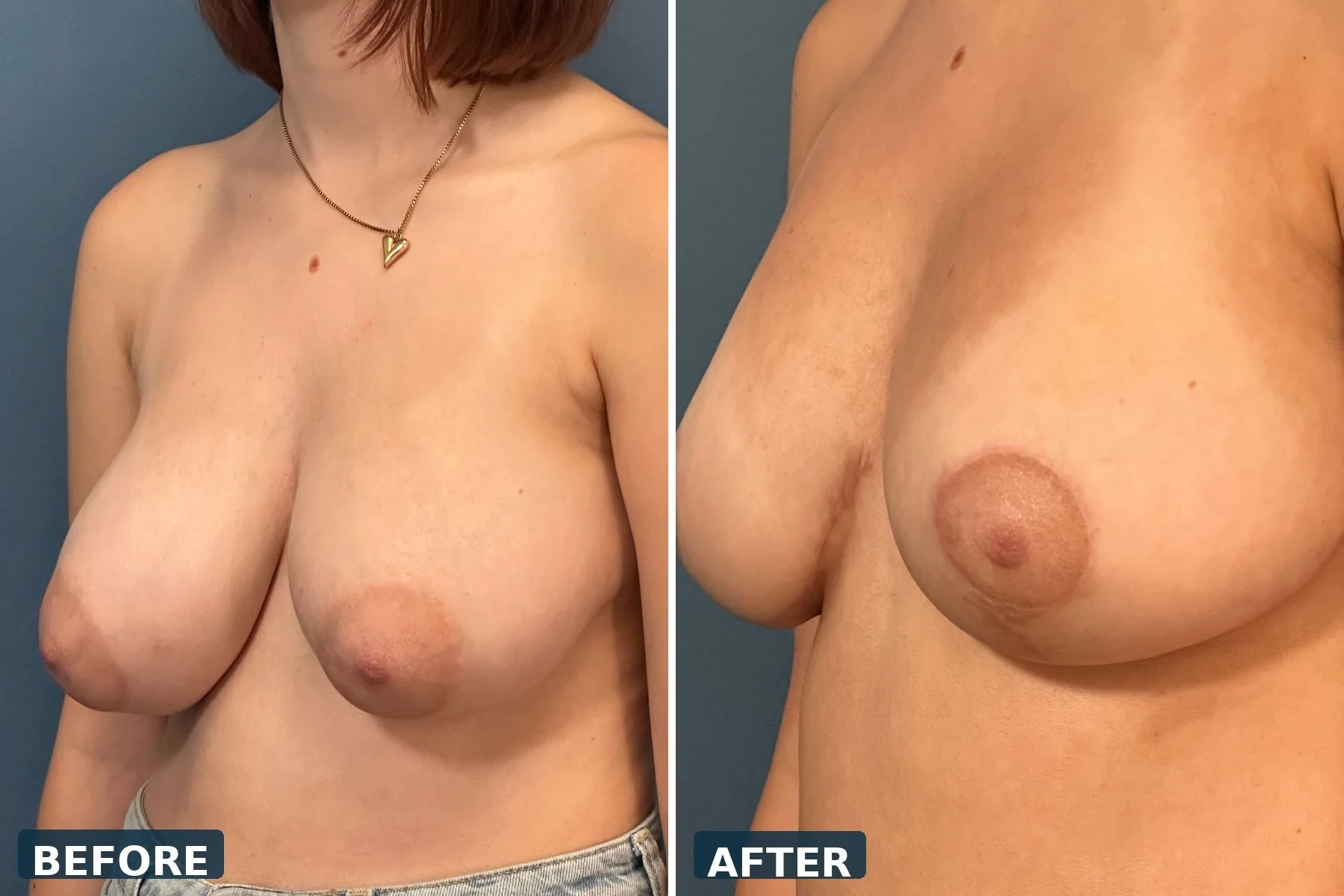 pearl-breast-reduction-case-09-three-quarter-right-before-after.jpg