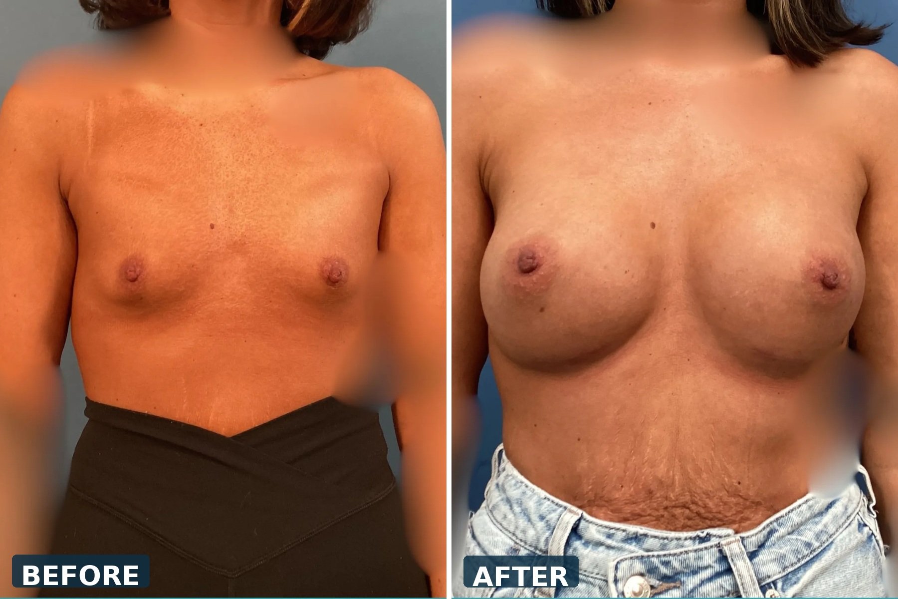 Breast Augmentation
