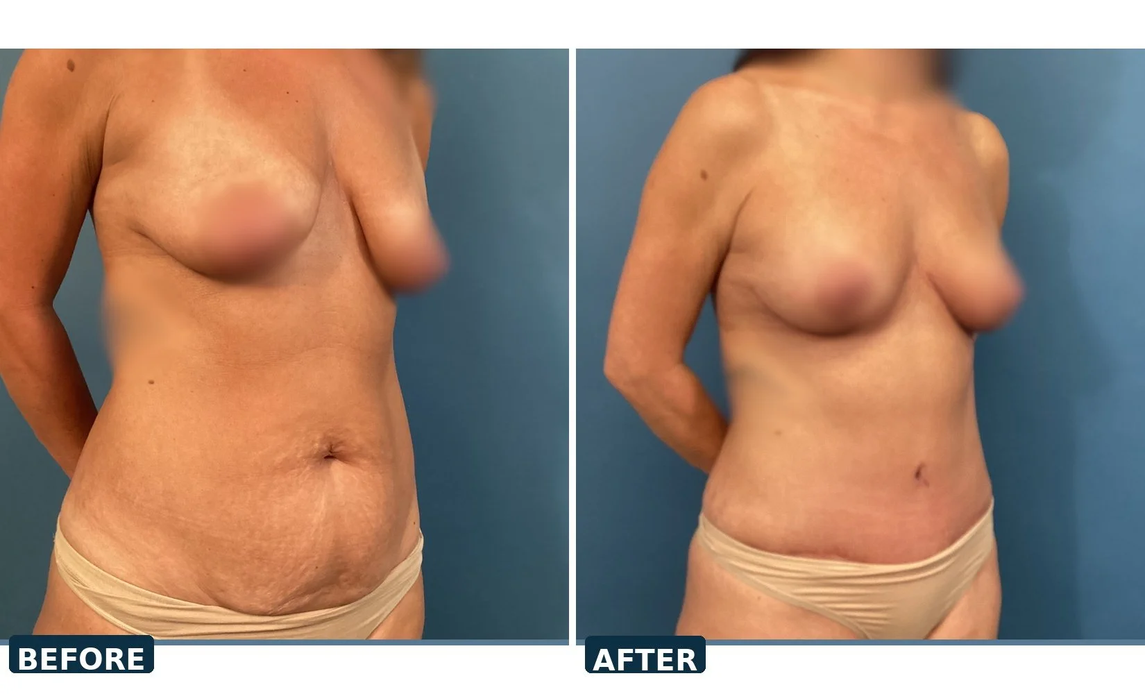 pearl-tummy-tuck-case-01-three-quarter-before-after.jpg