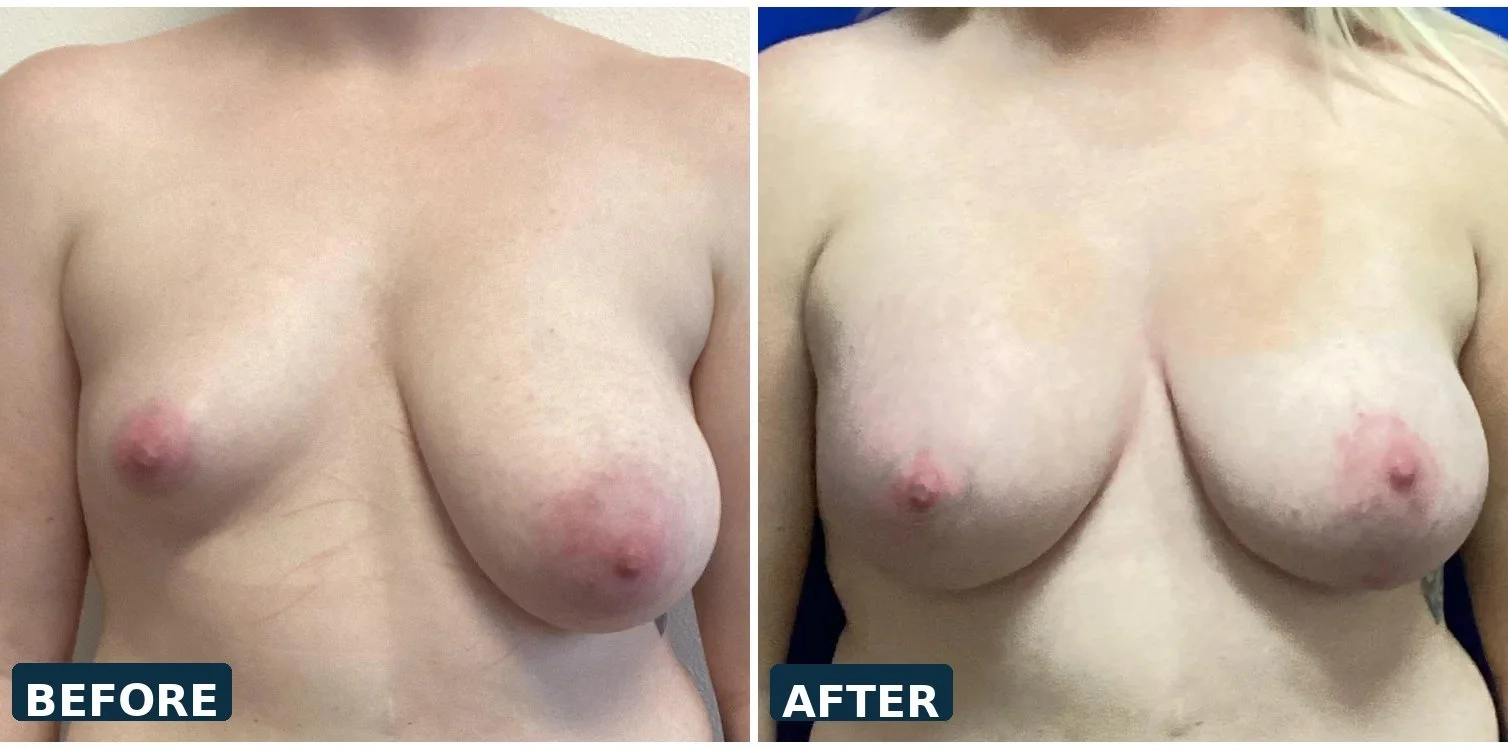 Right Breast Augmentation, Left Breast Lift