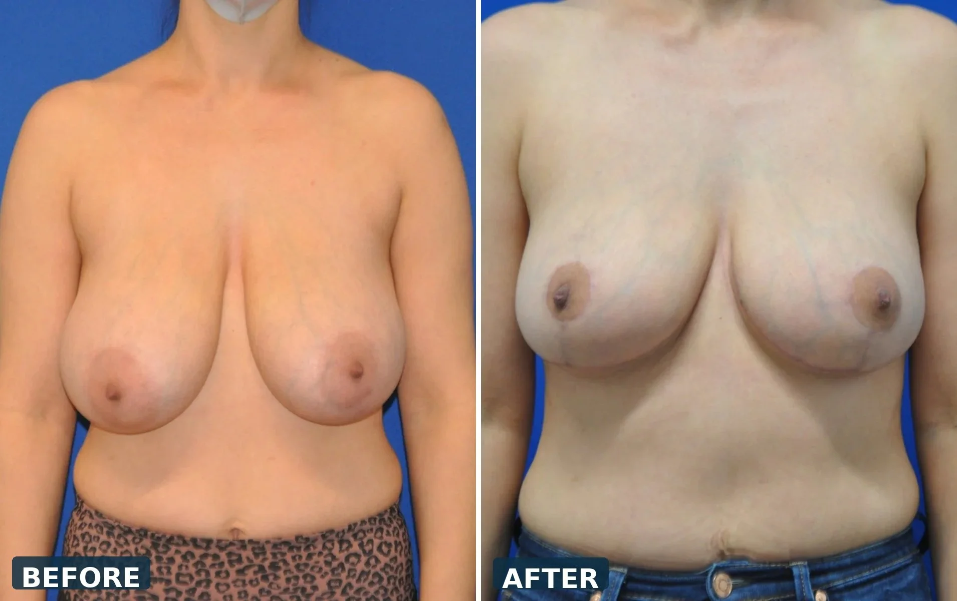 Breast Reduction