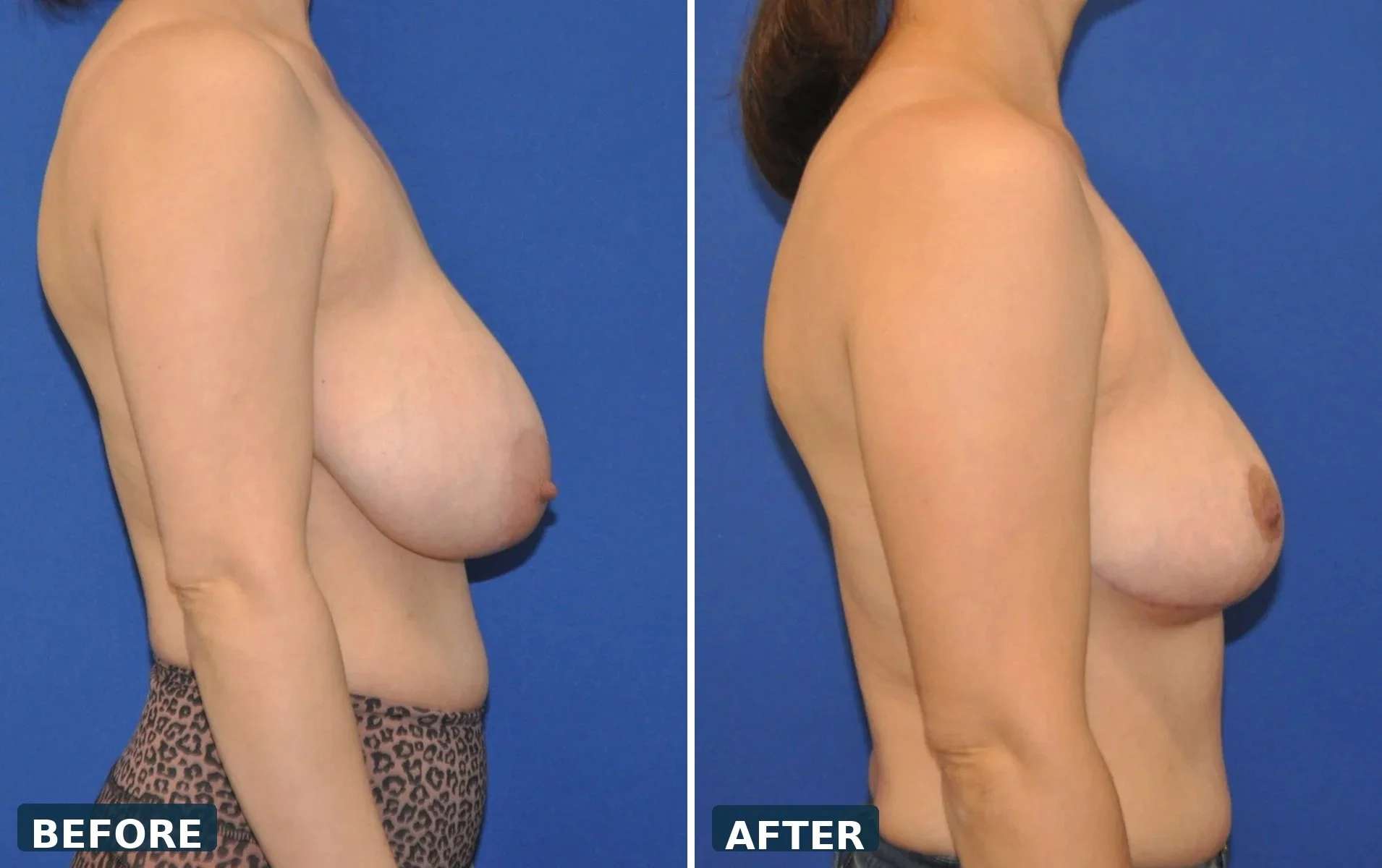 pearl-breast-reduction-case-04-profile-before-after.jpg