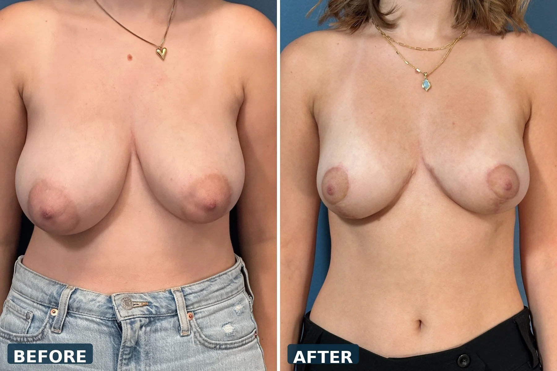 pearl-breast-reduction-case-09-front-before-after.jpg