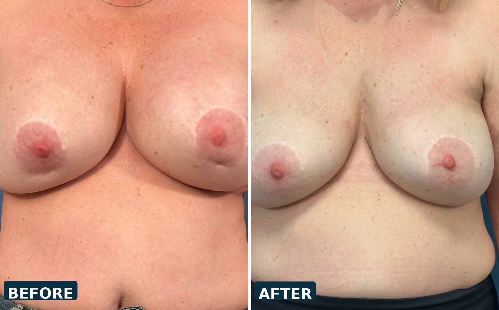 Bilateral Capsulectomy and Implant Exchange , and pocket switch with pocket repair