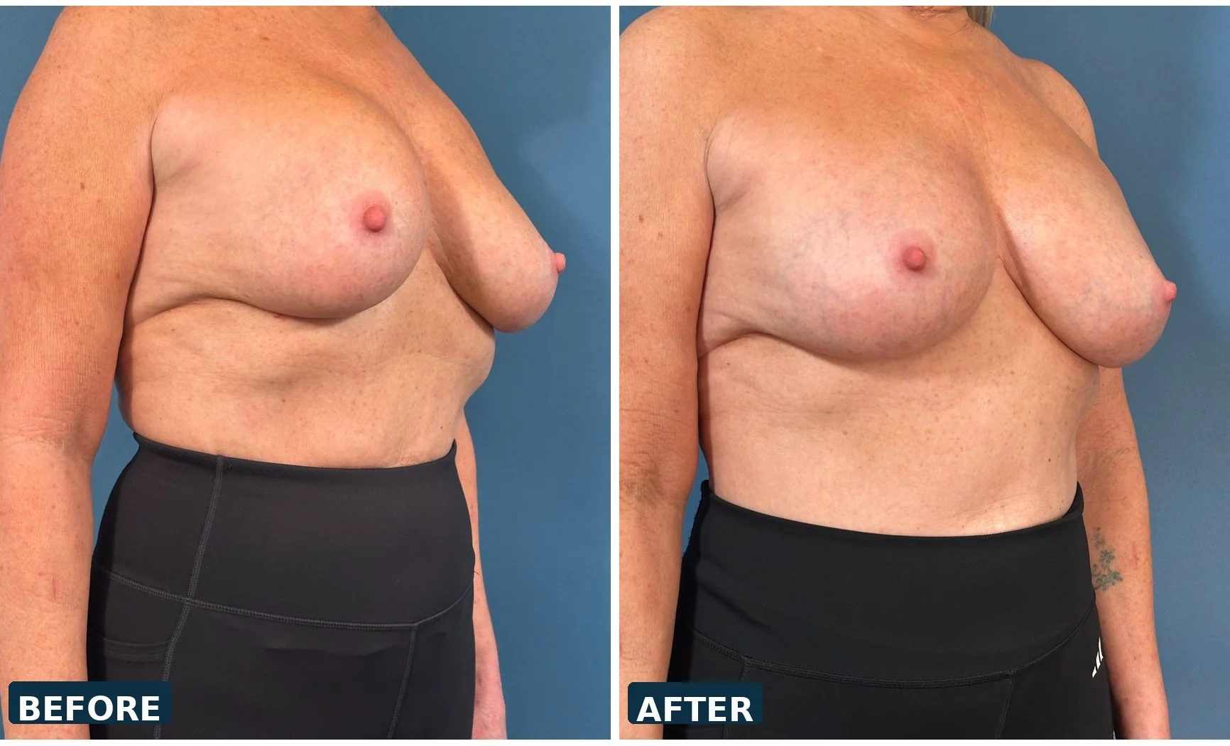 Bilateral Capsulectomy and Implant Exchange  treating capsular contracture 