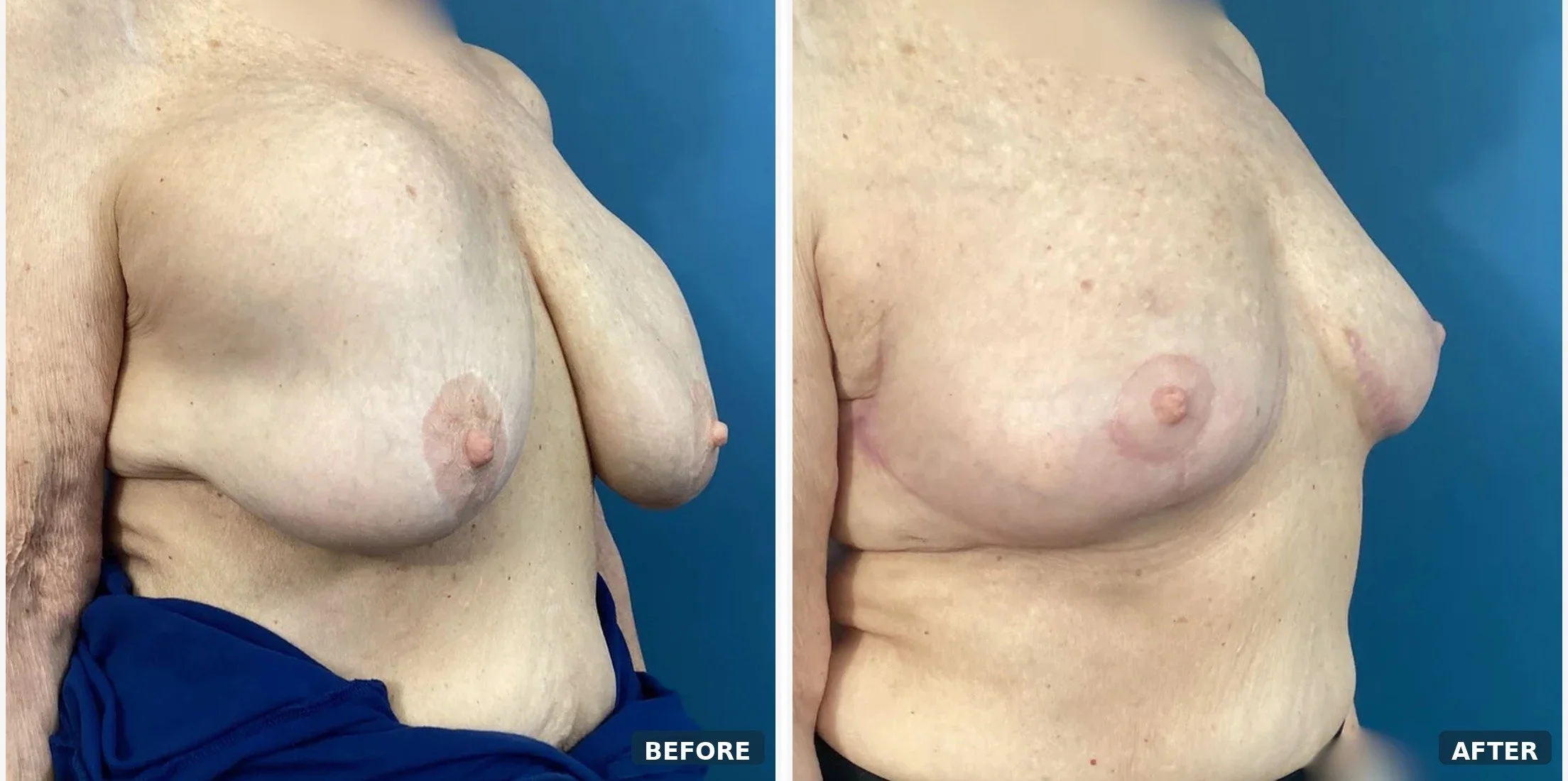 Bilateral Capsuiectomy & Implant Removal & Mastopexy