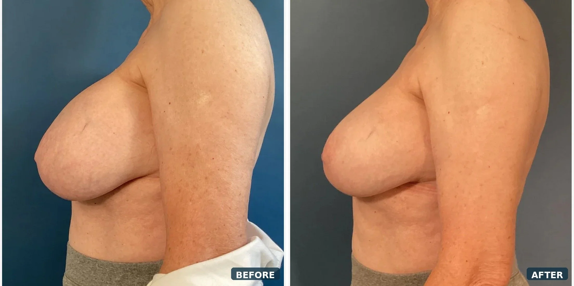 Bilateral Capsuiectomy & Implant Removal