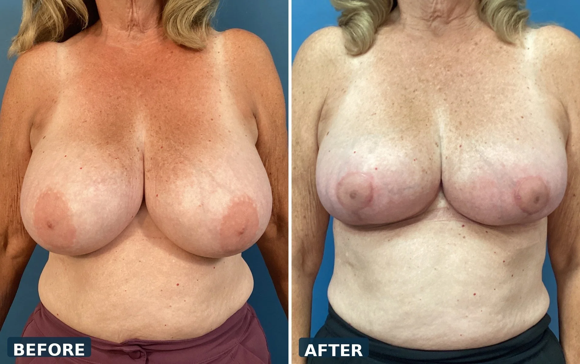 pearl-breast-reduction-case-06-front-before-after.jpg