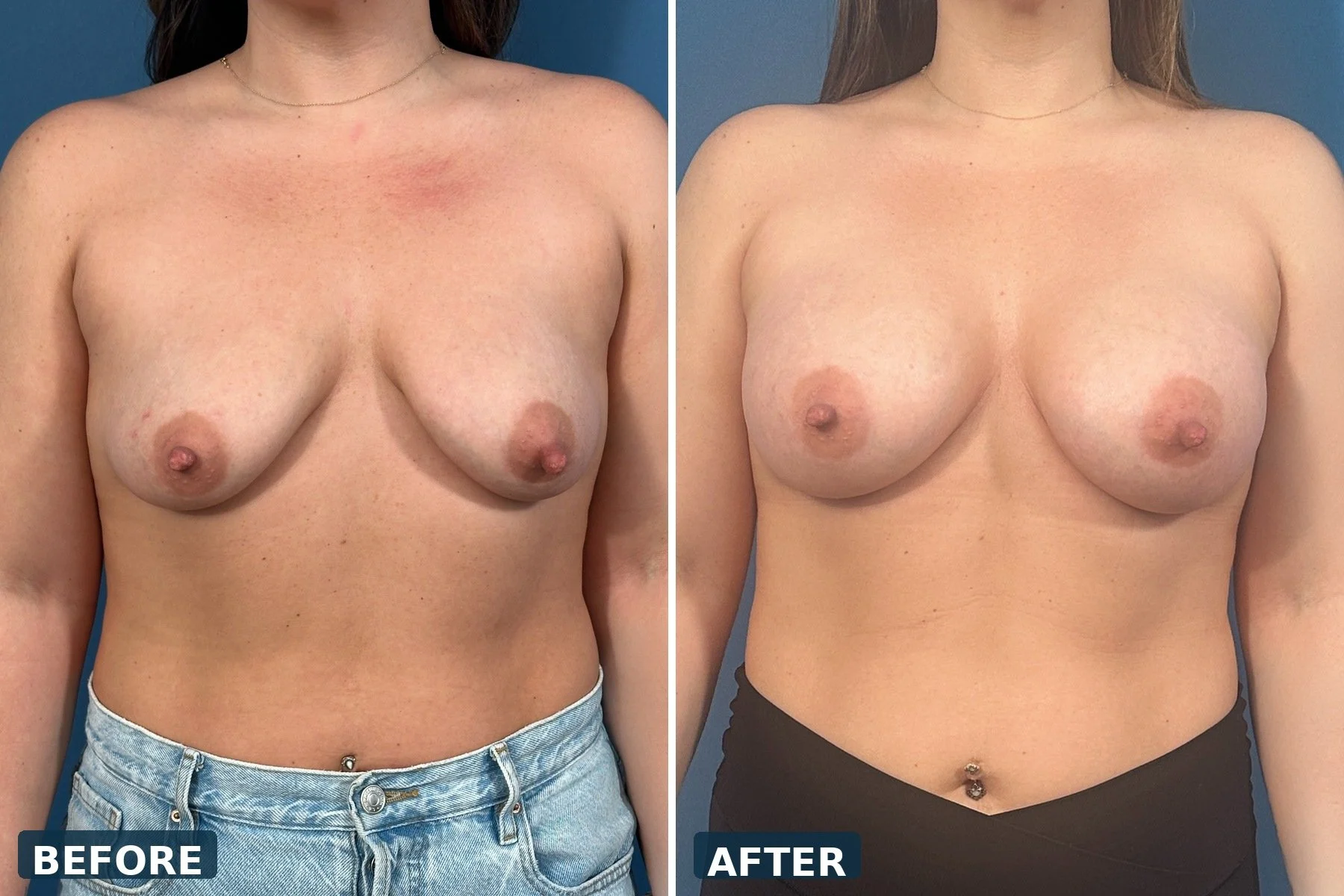 Motiva Breast Augmentation