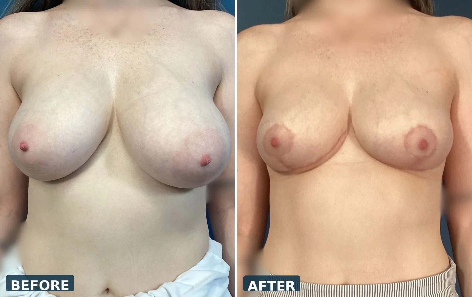 pearl-breast-reduction-case-01-front-before-after.jpg