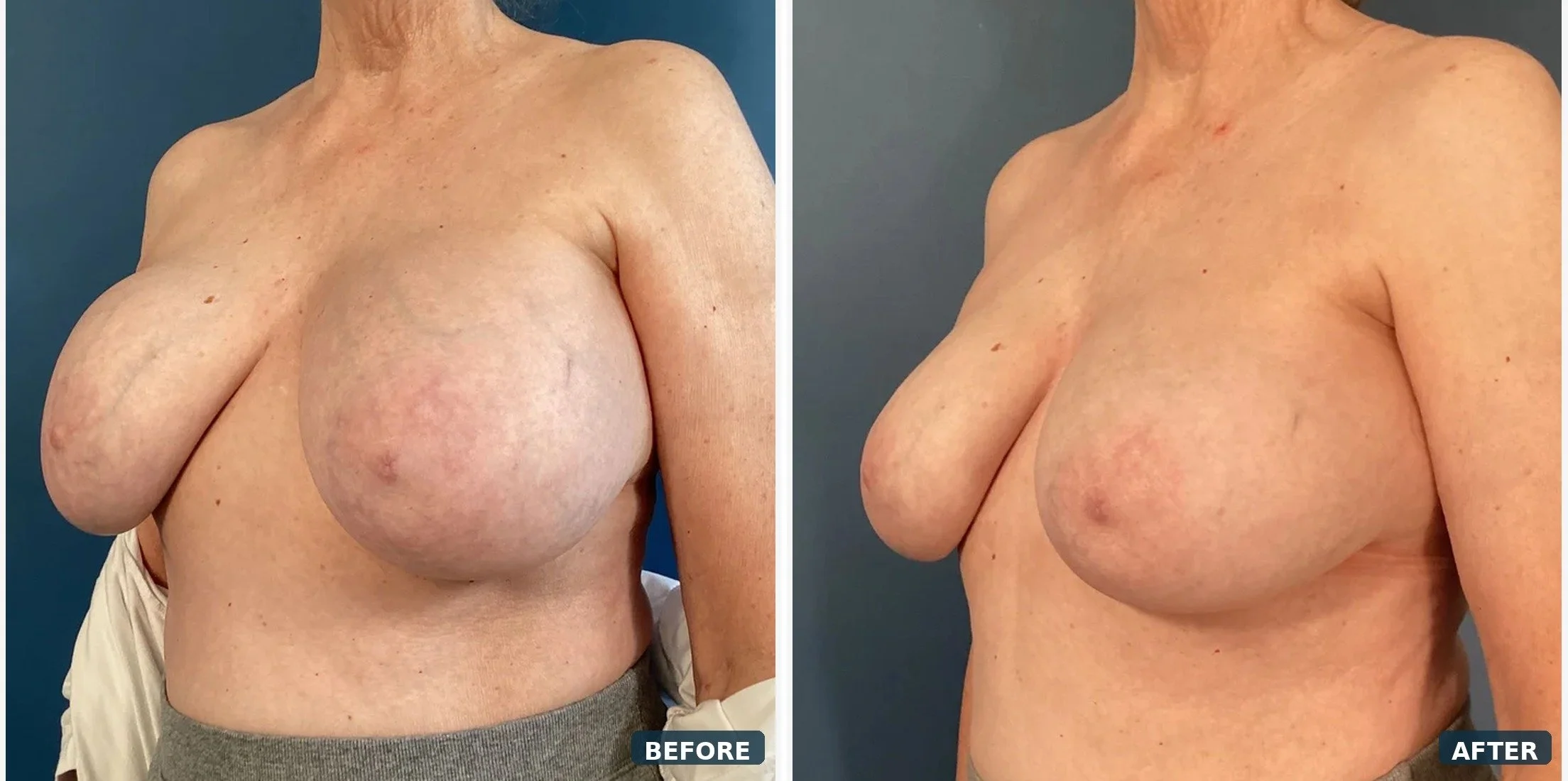Bilateral Capsuiectomy & Implant Removal