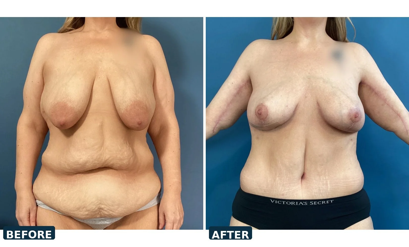 pearl-tummy-tuck-case-02-front-before-after.jpg