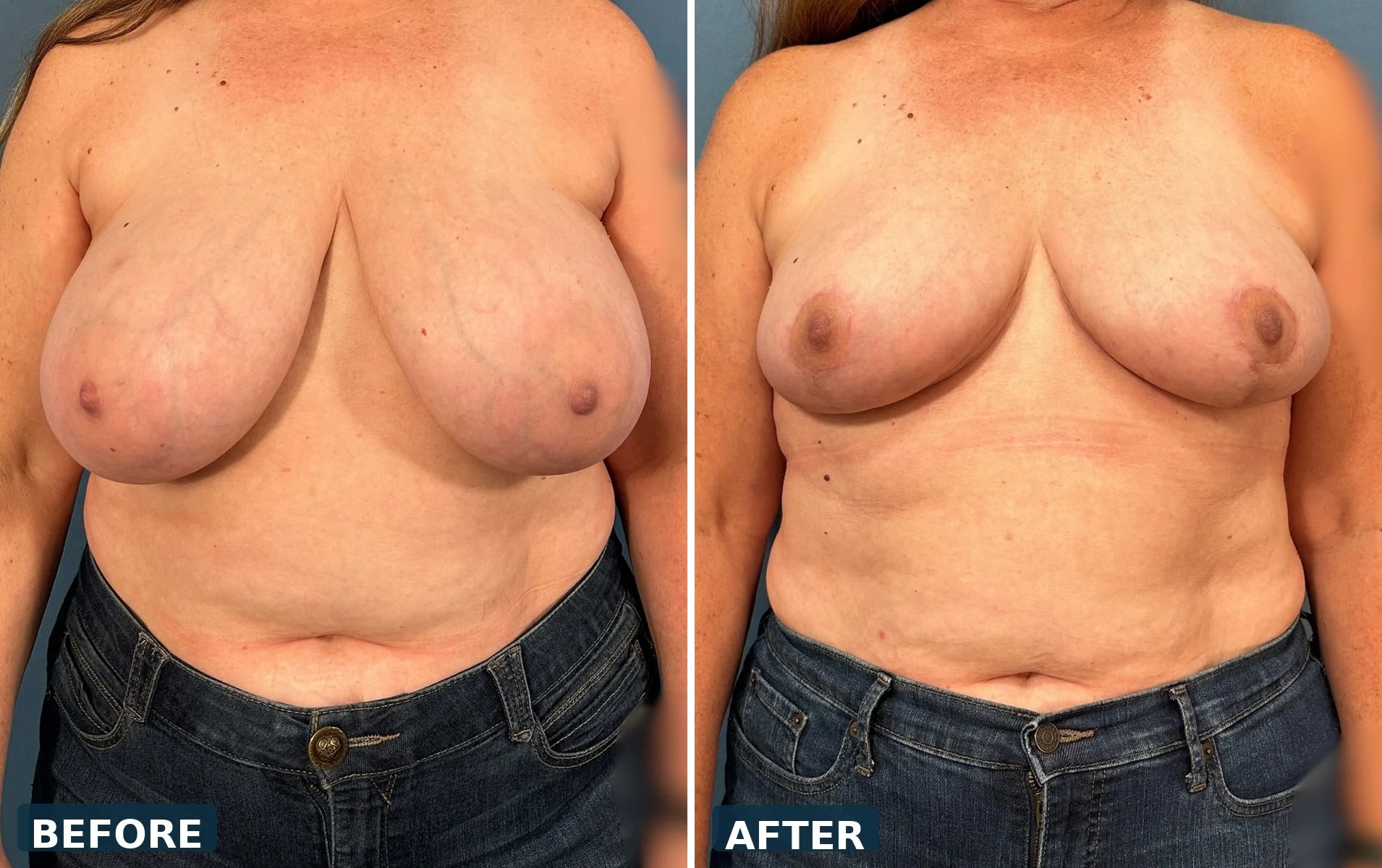 pearl-breast-reduction-case-07-front-before-after.jpg