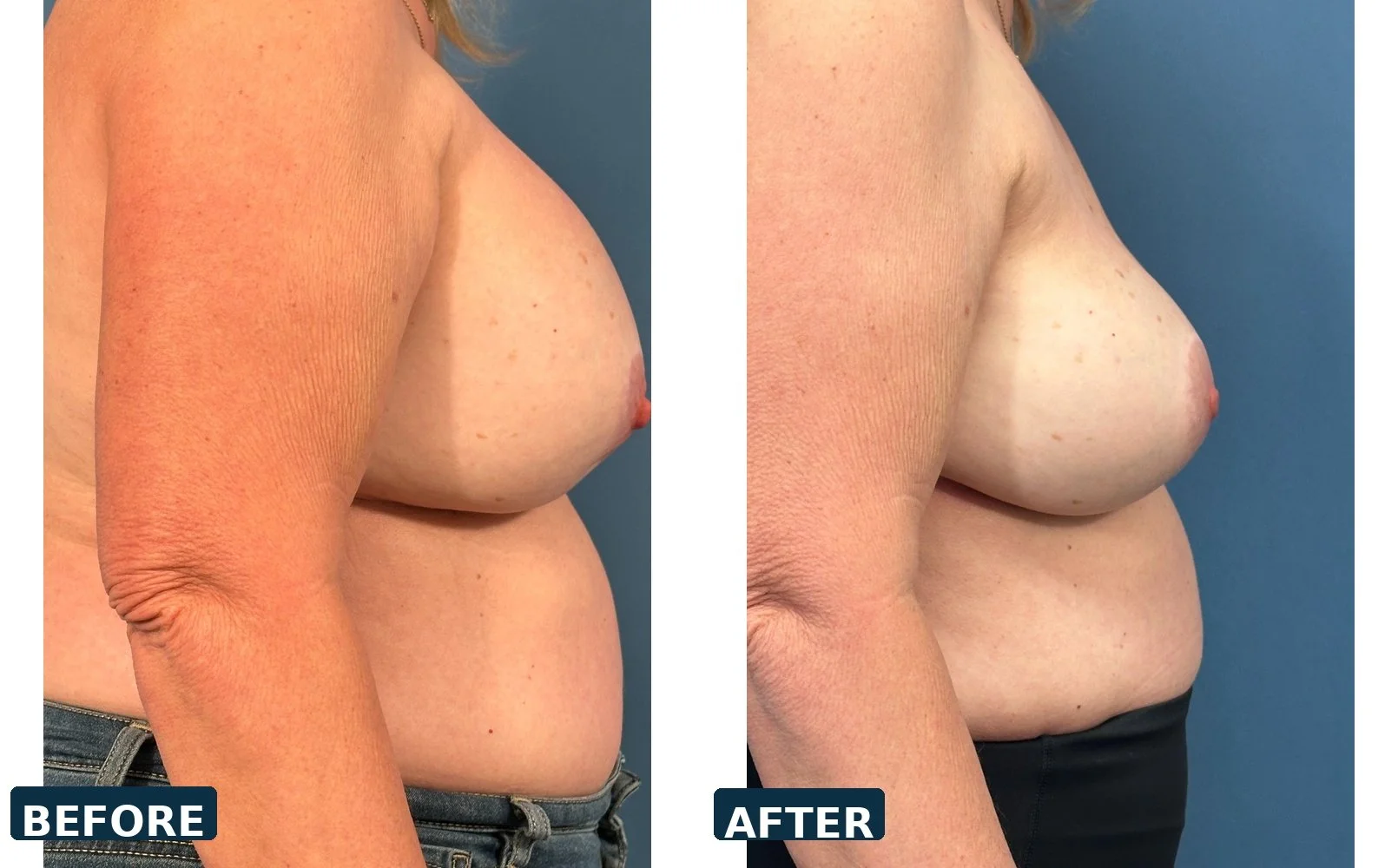 Bilateral Capsulectomy and Implant Exchange 