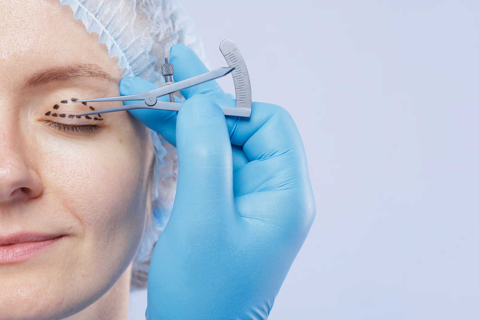 Upper Eyelid Surgery for a More Alert Appearance