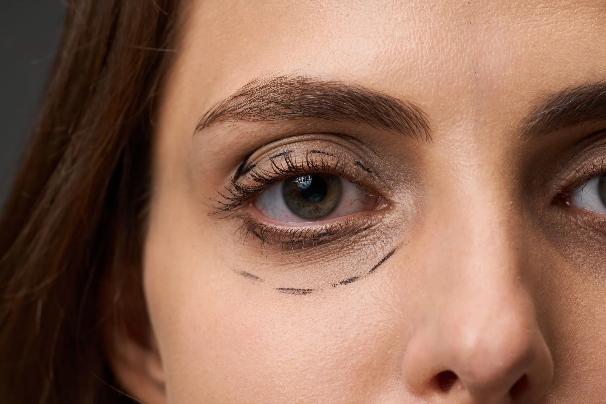 Eyelid Surgery vs Brow Lift: Which Addresses Your Concern?