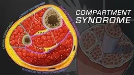 Let’s Talk About Compartment Syndrome
