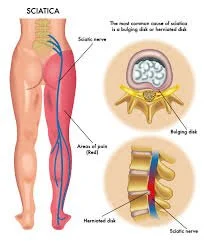 Sciatic Pain: What It Is and the Two Main Causes