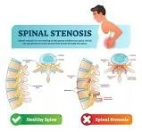 Understanding Spinal Stenosis: Cervical vs Lumbar Symptoms and Supportive Bodywork