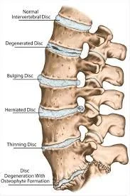 Degenerative Disc Disease (DDD): Understanding the Spine’s Wear and Tear Process
