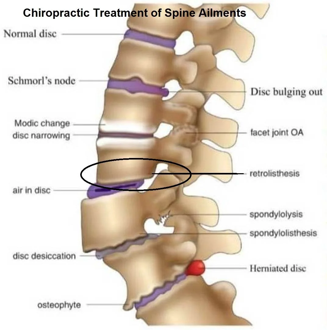 Understanding Spinal Retrolisthesis: Causes, Symptoms, and Treatment