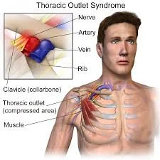 Neurogenic Thoracic Outlet Syndrome: The Most Common Presentation