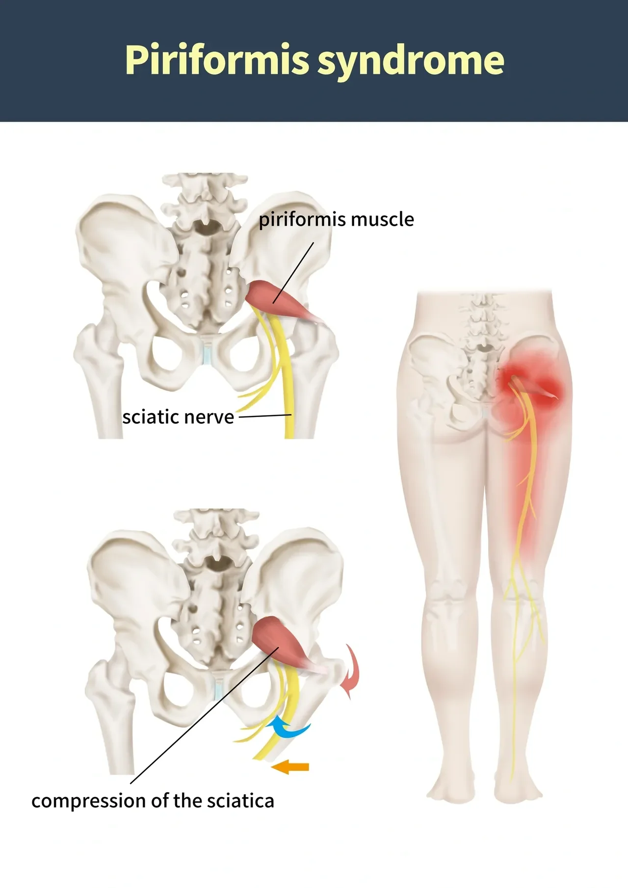 Piriformis Syndrome