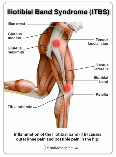 Understanding IT Band Syndrome: Causes, Symptoms, and Recovery