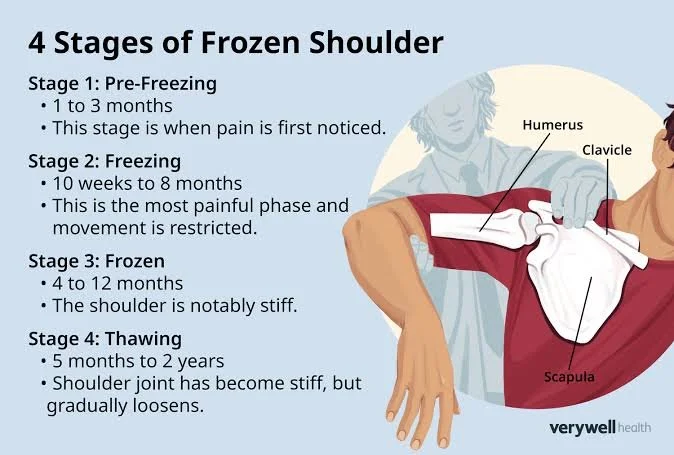 Frozen Shoulder (Adhesive Capsulitis): Detailed Overview