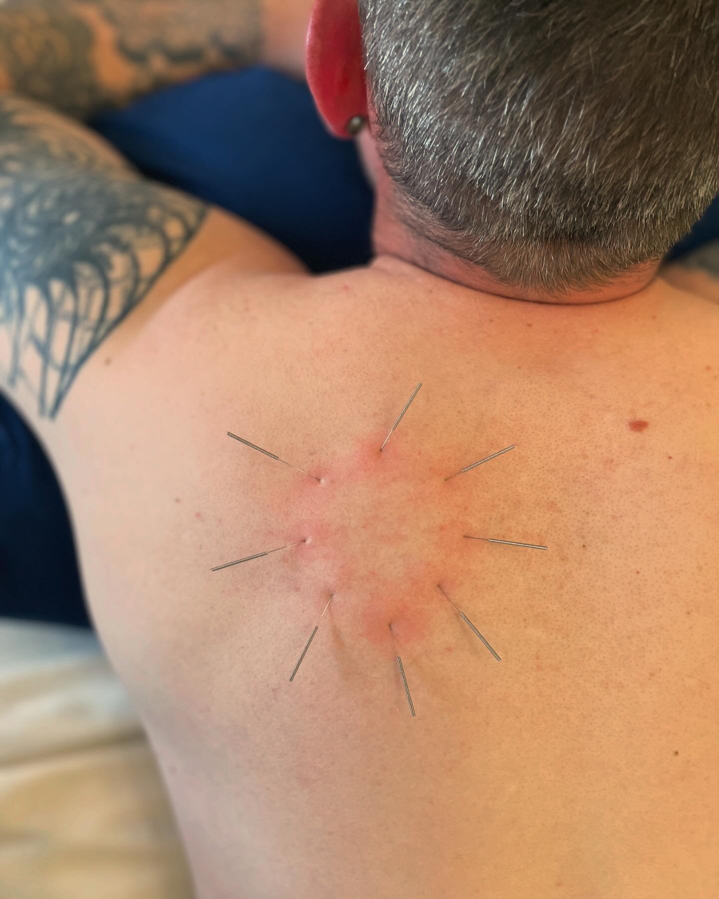 ✧ S U R R O U N D I N G  T H E  D R A G O N ✧

Typically a technique used to treat scars or lesions that will not heal. Sometimes, circling the dragon is the ideal way to get rid of stubborn knots. 

Meet a recent patient of mine who does a lot of ma