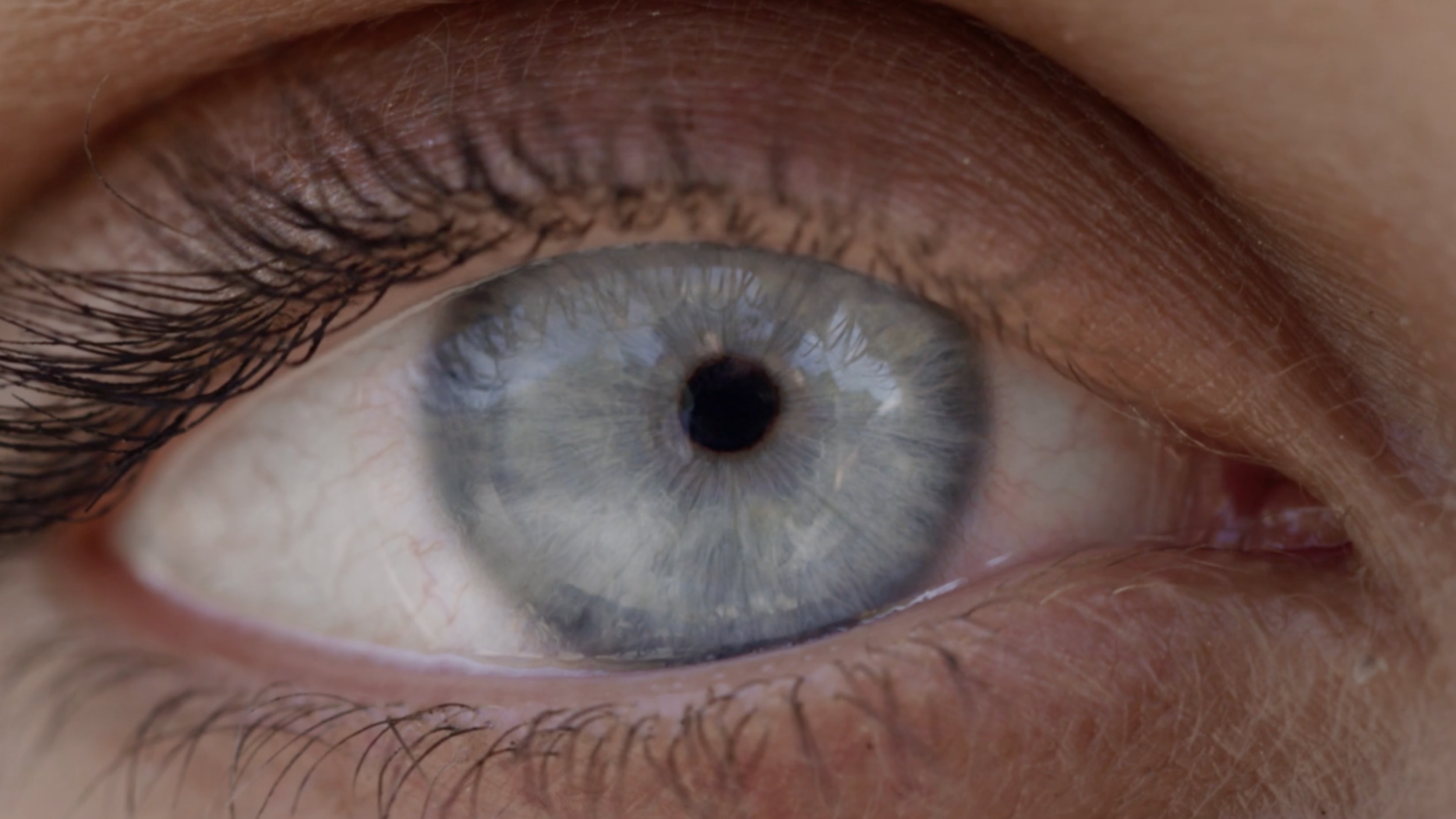 Visian ICL Thumbnail.png