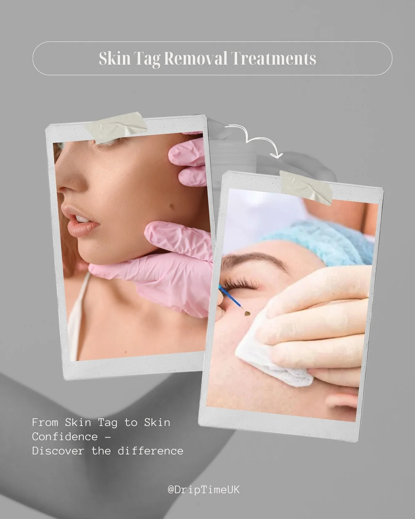 ✨ Smooth, glowing skin starts with the details ✨

Skin tags are common and harmless, but we 
know they can sometimes get in the way of your confidence. Our skin tag removal treatment is designed to gently and effectively clear away those little bumps