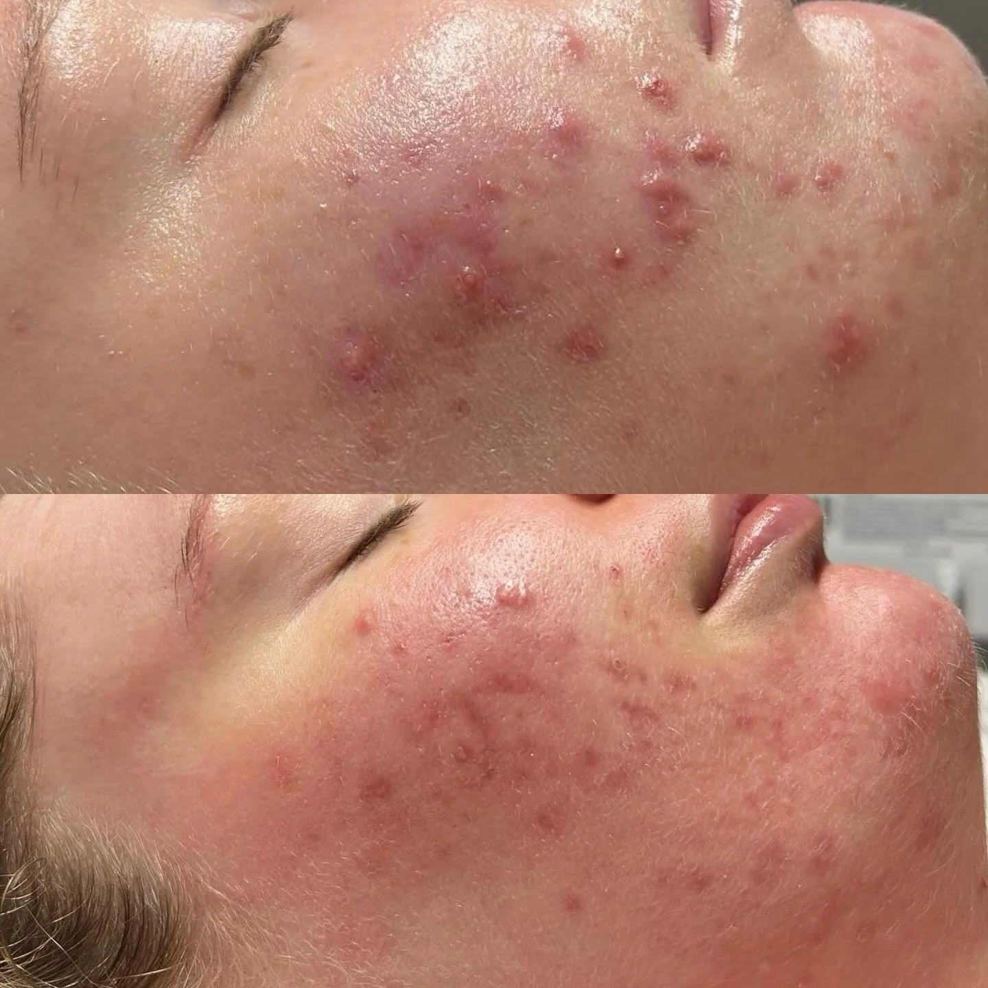 ✨ From Active Breakouts to Clearer, Calmer Skin ✨

This beautiful skin has been on a journey from painful, inflamed breakouts to a calmer, healthier complexion 

At Niswaan Skin &amp; Beauty, we focus on treating the root cause rather than just the s