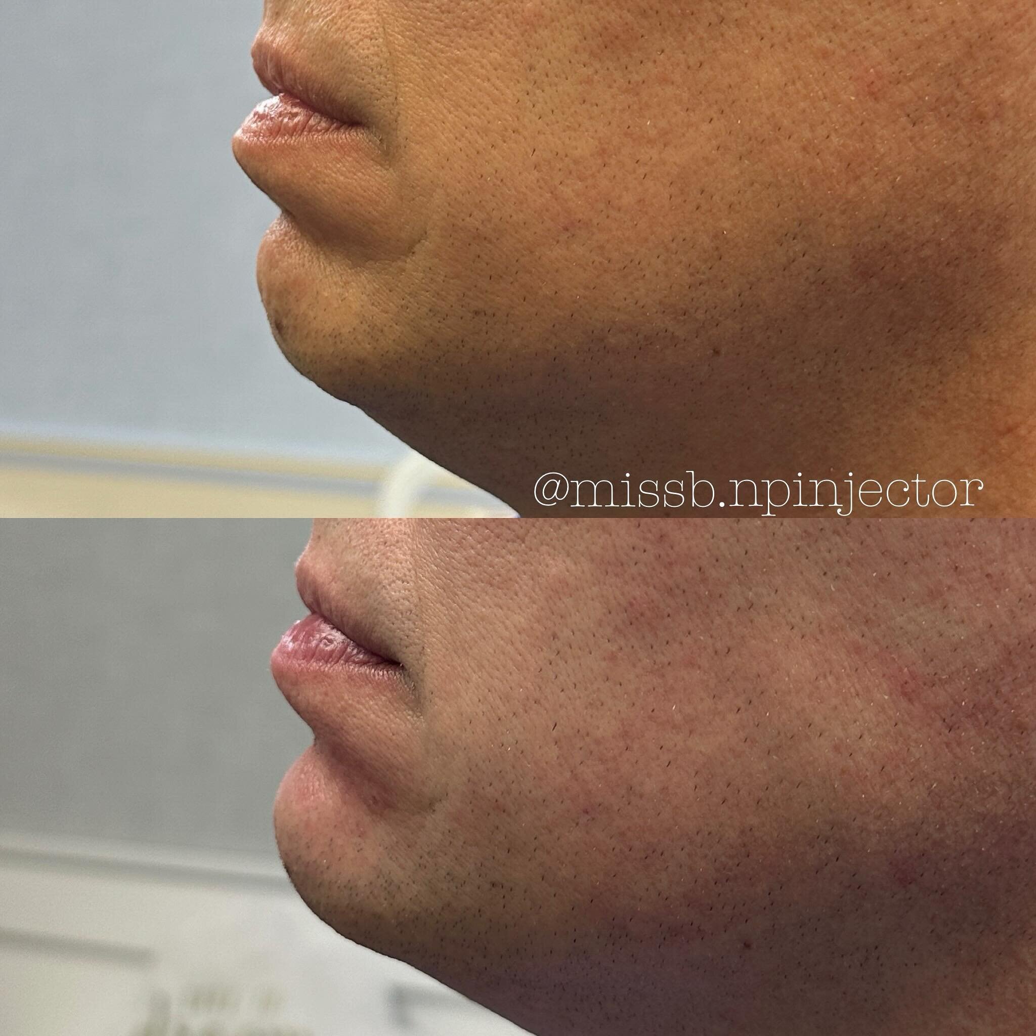 Correction of a weak chin to provide anterior projection is a simple treatment that can have a big impact. 

Selection of the proper product for this area is key. I used Restylane Shaype for the first time on this client and I was impressed with the 