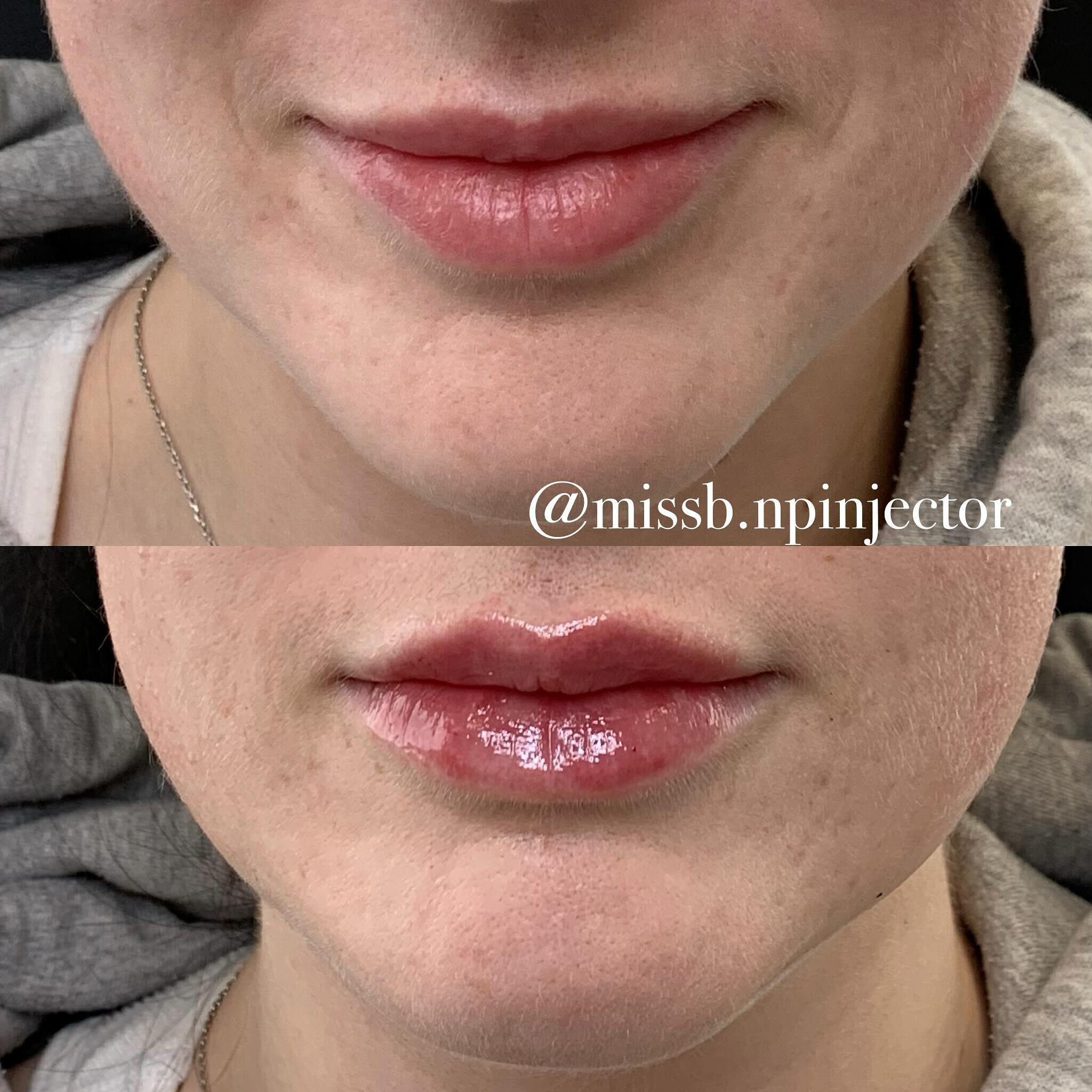 It may be snowing AGAIN but these lips are 🔥!
@bk.luxe 
#beforeandafter #lipfiller #liprefresh #saturday #npinjector #miramichi