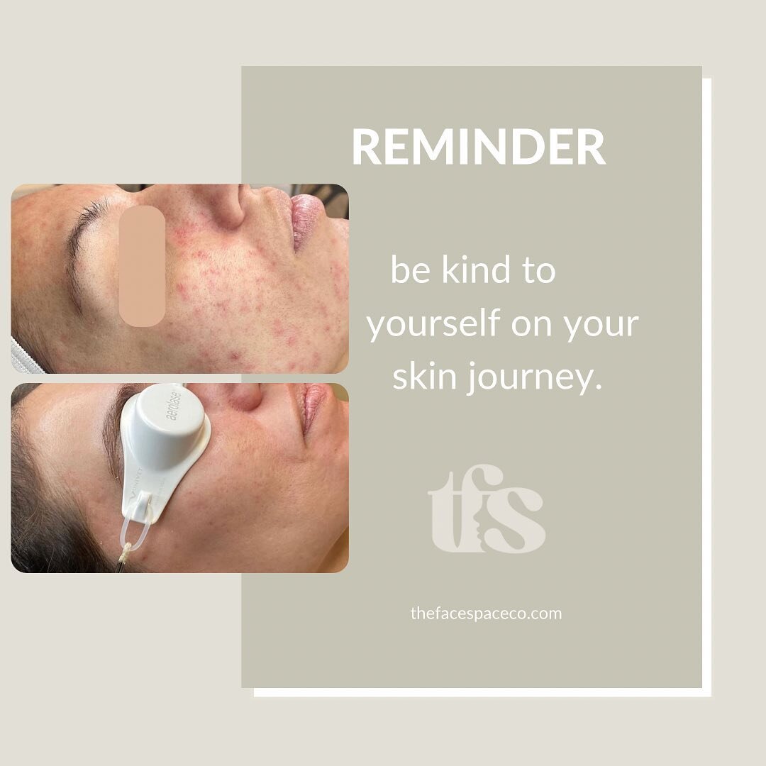 Friendly reminder&hellip; be kind to yourself on your skin journey. Comment a &ldquo;🤍&rdquo; if you needed this reminder. 

We know how lonely + overwhelming it can be dealing with skin concerns. 

Our goal is always to help you achieve your health