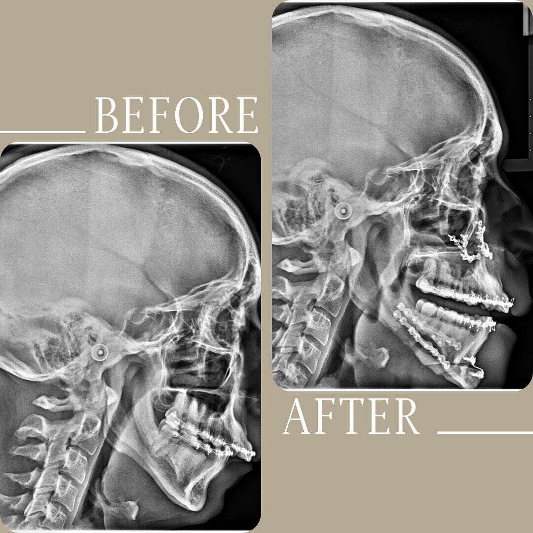 Patient Case: 31 yo male with history of chronic nasal congestion, mouth breathing, heavy snoring and significant daytime fatigue and mental fog. He also had an anatomically narrow airway secondary to a skeletal malformation causing him sleep disrupt