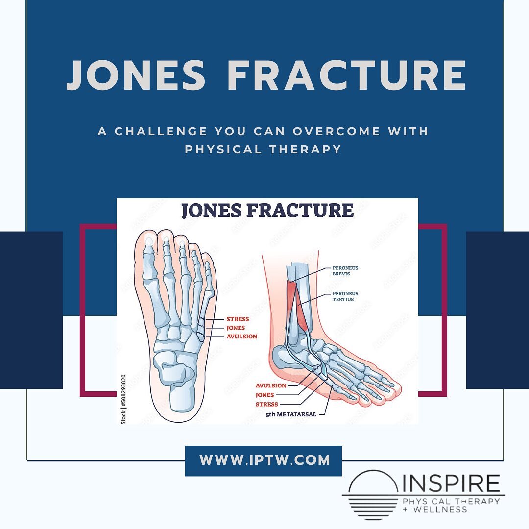 What is a Jones fracture? 
It is a break in the fifth metatarsal bone of the foot, often caused by overuse, repetitive stress, or trauma. This type of fracture can be challenging to heal due to their location and blood supply.

Why do they happen? 
T