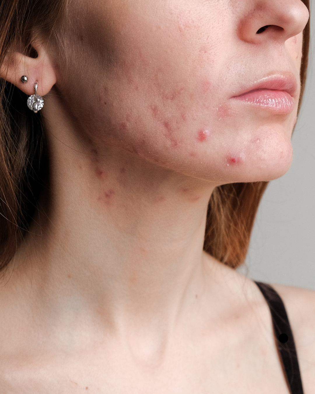 The Truth About Diet and Acne: What the Research Really Says