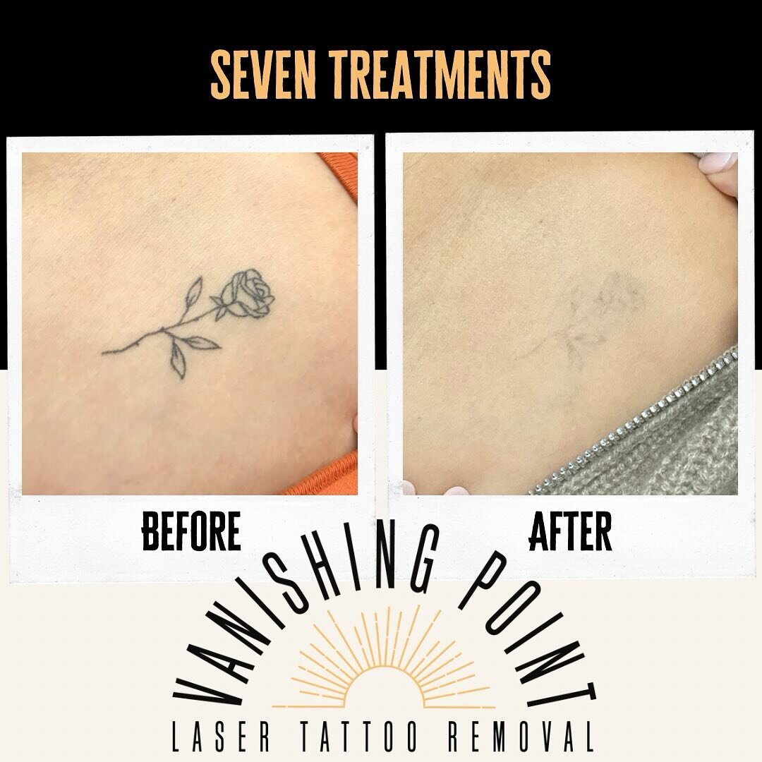 Laser Tattoo Removal | Chicago Aesthetics MedSpa