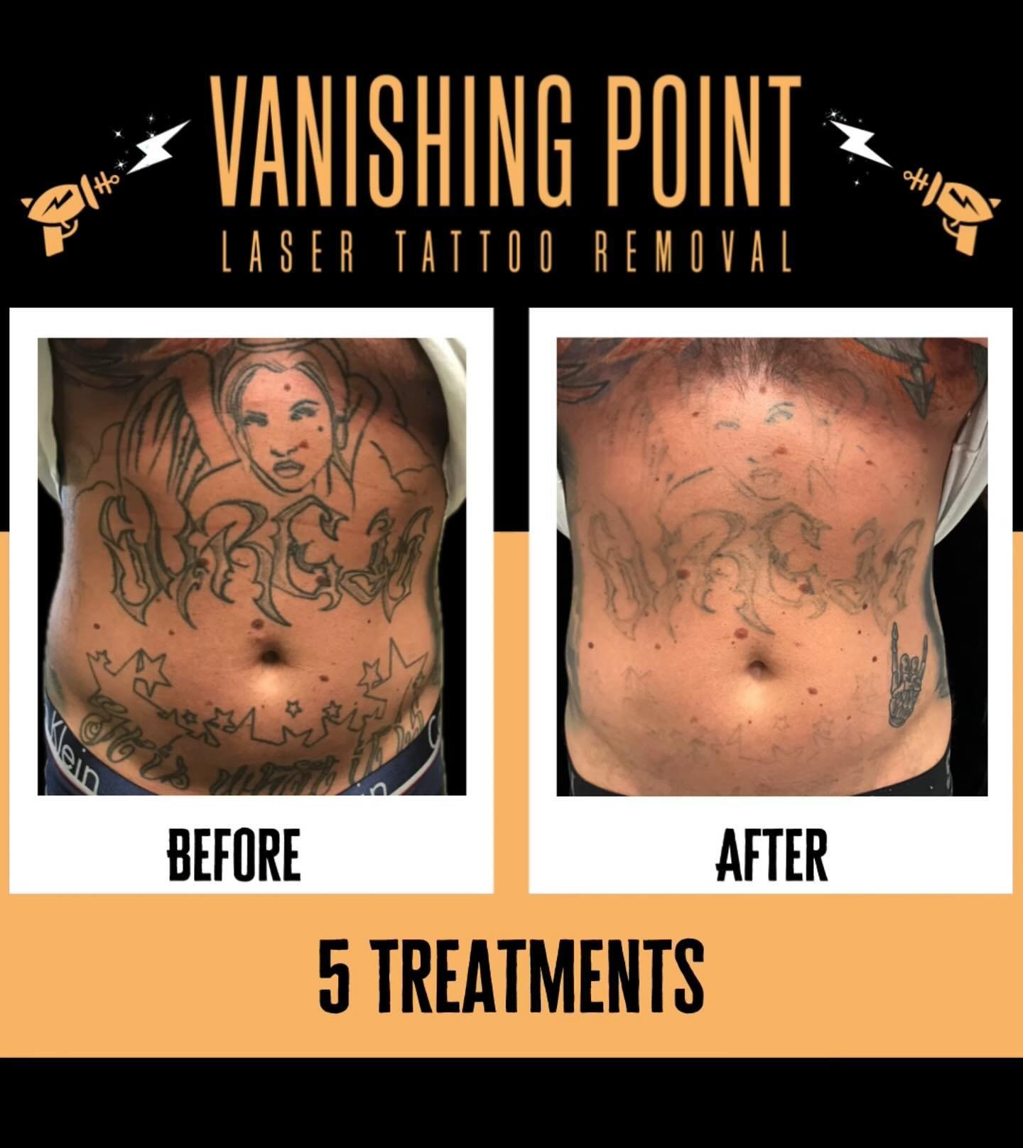 Wow, check out the fading on this stomach tattoo! 🤩 Book a free consultation from our website today and get your unwanted tattoo taken care of!⚡️#stomachtattoo #laser #vanishingpoint #picodiscovery #progress #lasertattoo #tattooremoval #tattooremova