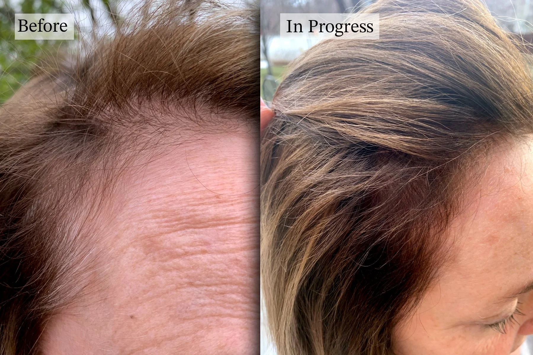 Find Hair Loss Center Near Me for Comprehensive Balding Solutions