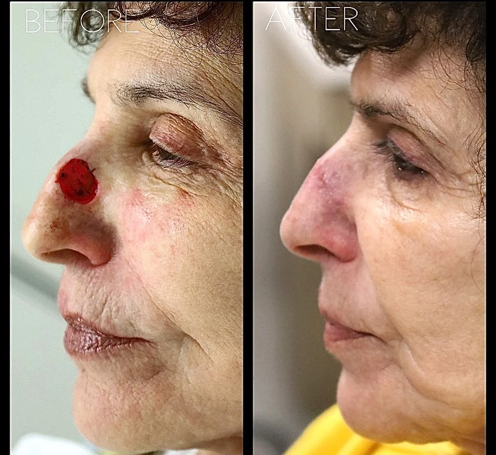 This patient had a large skin cancer removed from her nose. She was nervous about whether she would look “normal” after reconstructive surgery with me. Here she is 3 months after reconstruction surgery in Dr. Kumar’s office— she’s back to her social 