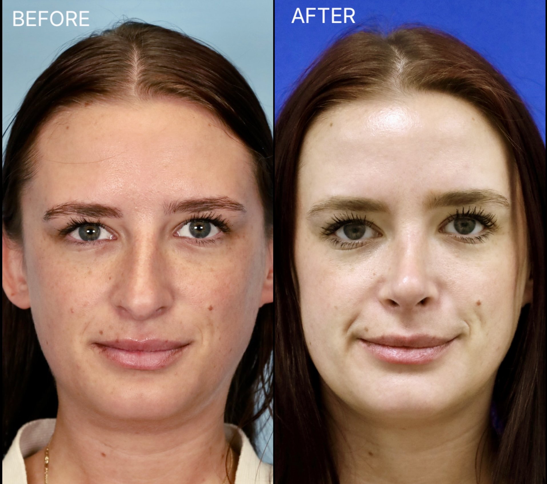 This female patient wanted to address the dorsal hump, decrease the nasal projection, and refine the nasal tip. After 10 months, the soft tissue swelling continues to decrease, and her nose is healing beautifully