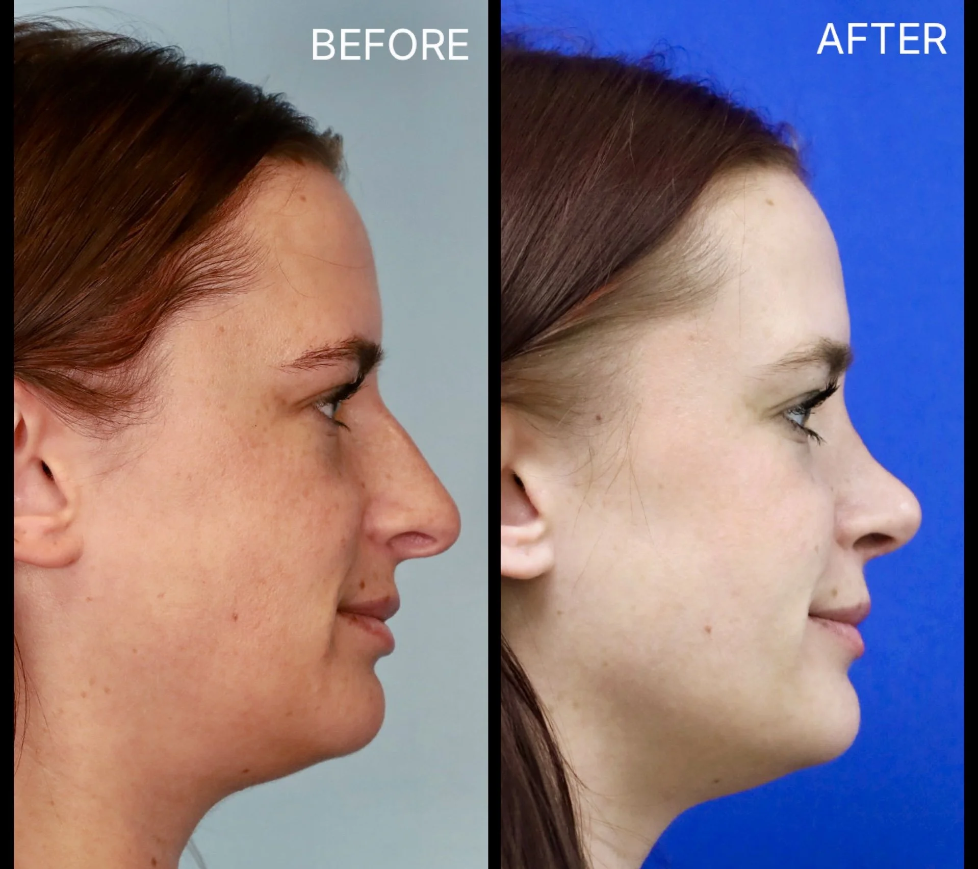 This female patient wanted to address the dorsal hump, decrease the nasal projection, and refine the nasal tip. After 10 months, the soft tissue swelling continues to decrease, and her nose is healing beautifully