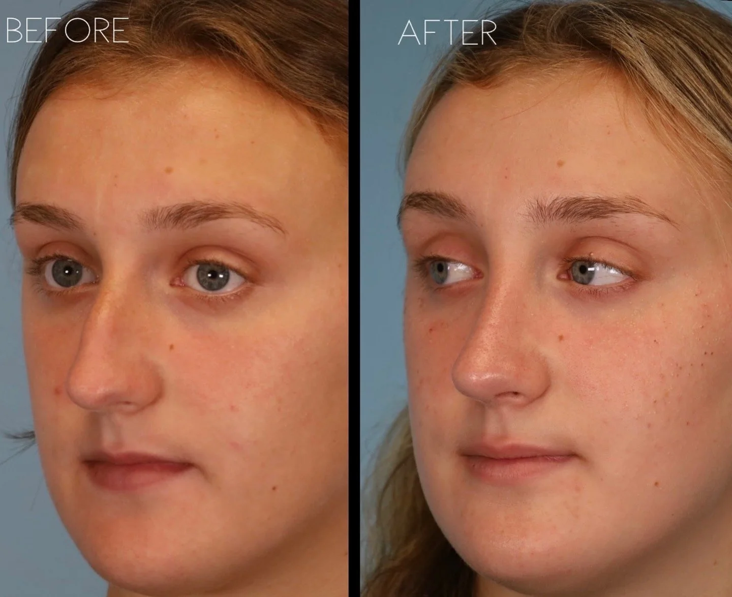 This 18 year old  patient wanted to address the dorsal hump and refine the nasal tip, in addition to improving her nasal breathing.