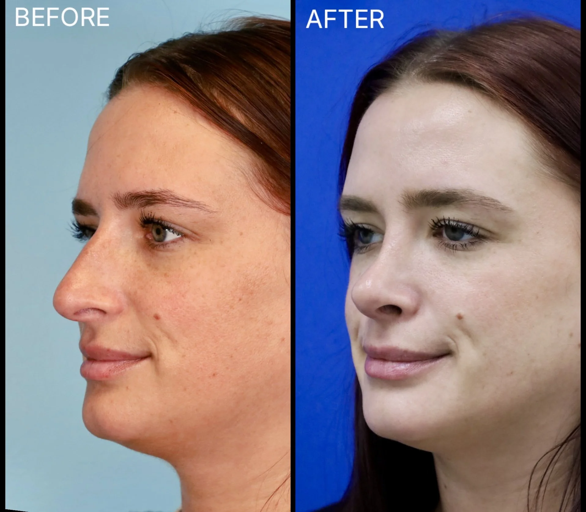 This female patient wanted to address the dorsal hump, decrease the nasal projection, and refine the nasal tip. After 10 months, the soft tissue swelling continues to decrease, and her nose is healing beautifully